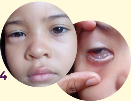 Rifa solidária busca custear cirurgia de criança batalhense com cisto no olho